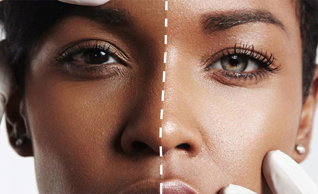Cosmetic Fillers
